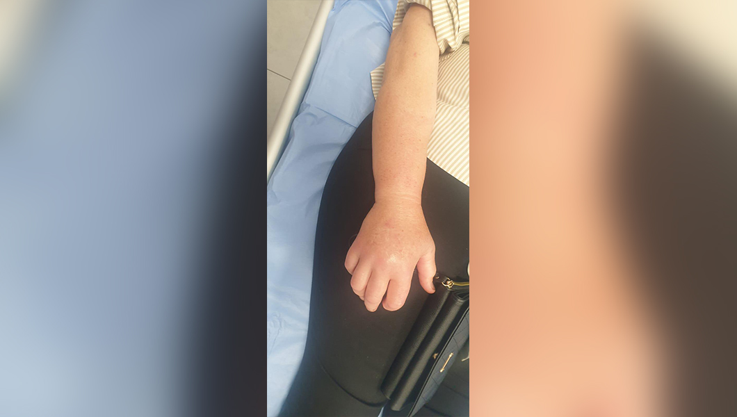 O femeie de 71 de ani a ajuns la urgențe după ce a fost mușcată de o viperă