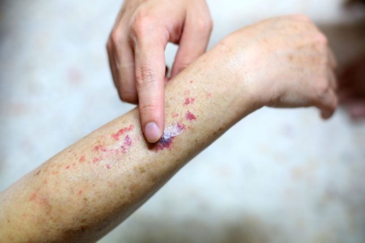 Purpura fulminans, o afecțiune medicală severă și rară! Iată la ce simptome trebuie să fii atent!