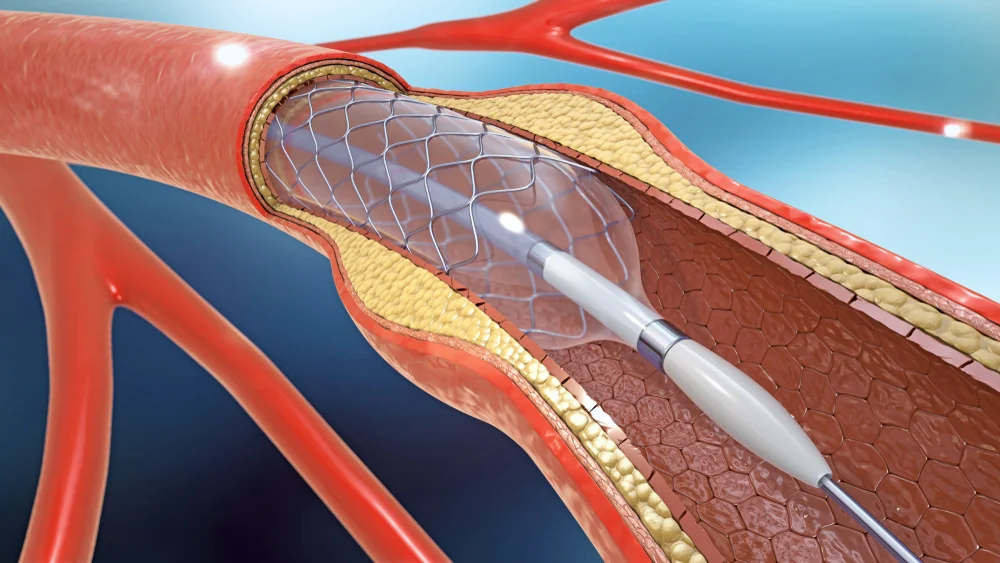 Prețul real pentru montare de stent la inimă și ce factori pot influența schimbărea acestuia
