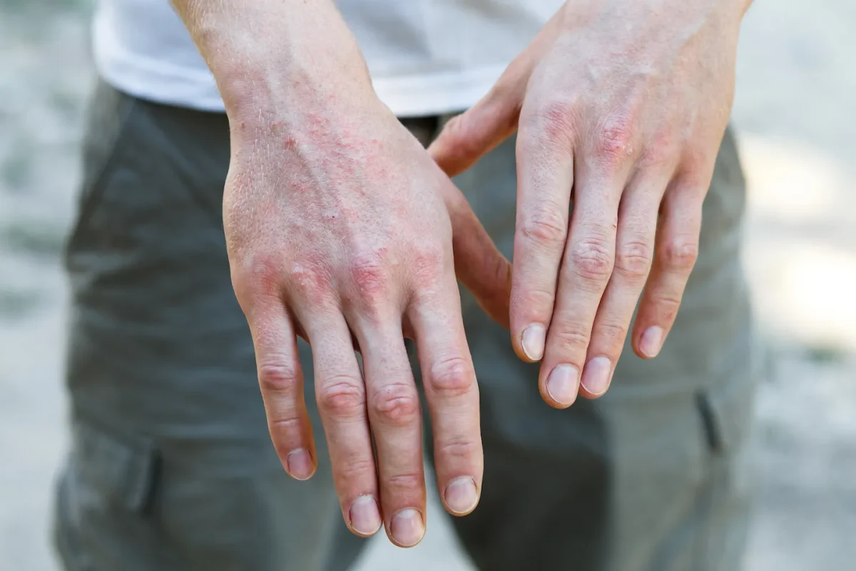 Cum arată psoriazis la început. Iată la ce simptome trebuie să fii atent!