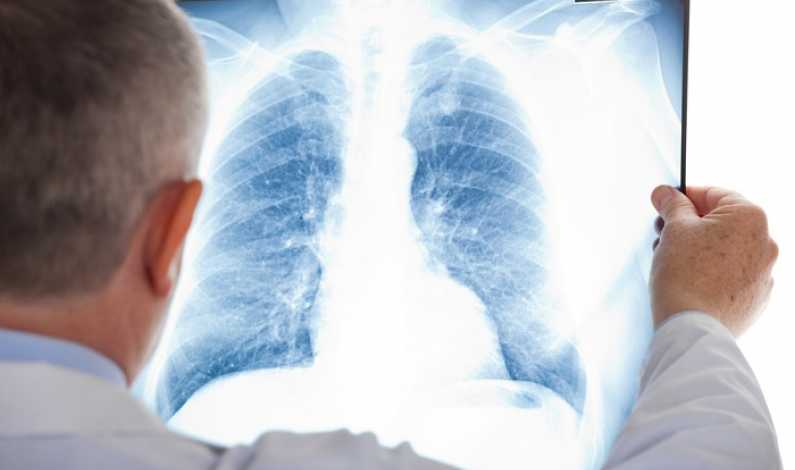 Toate persoanele de peste 18 ani pot beneficia, de la 1 iulie, de radiografii pulmonare gratuite! Trebuie doar să se prezinte la medic cu o copie a cărții de identitate