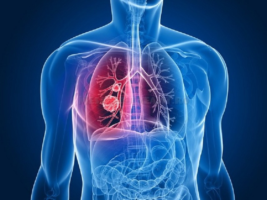 TBC simptome, cauze și tratament. Cum să recunoști tuberculoza înainte să devină gravă