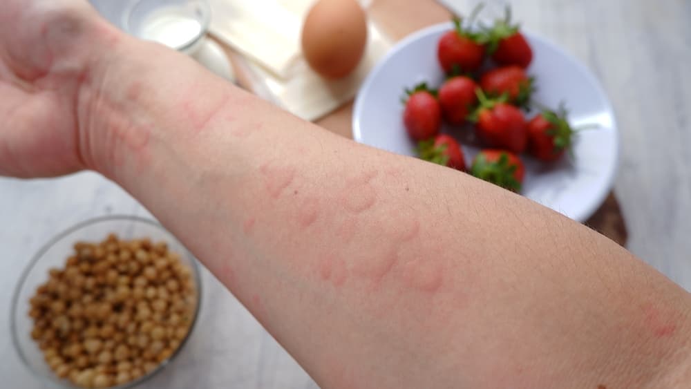 Cât durează o alergie alimentară? Iată ce opțiuni de tratament există!