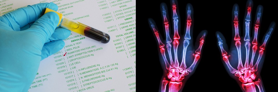 În ce constă factorul reumatoid și când se recomandă această analiză? Află cum se măsoară și ce boli indică!