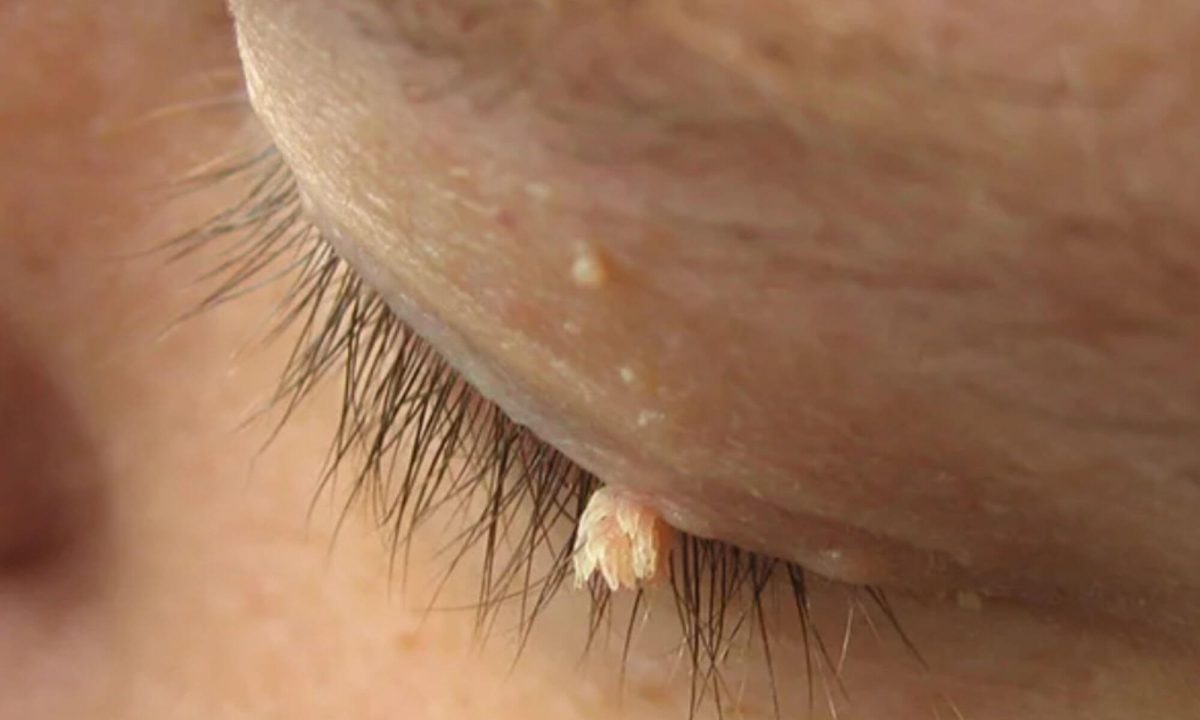 Există tratament pentru virusul HPV? Iată cum să previi infectarea!