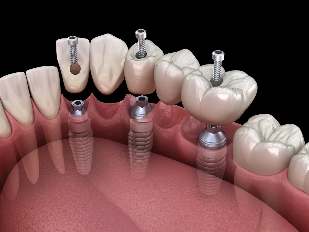 Îți poți face implant dentar gratuit? Iată tot ce trebuie să știi!