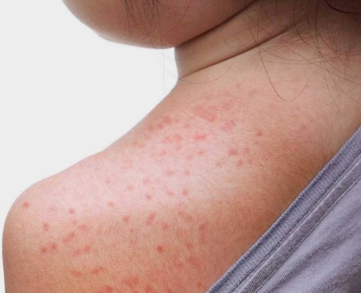 Miliaria, erupția provocată de căldură. Cum recunoști iritația și ce măsuri să iei pentru a o preveni