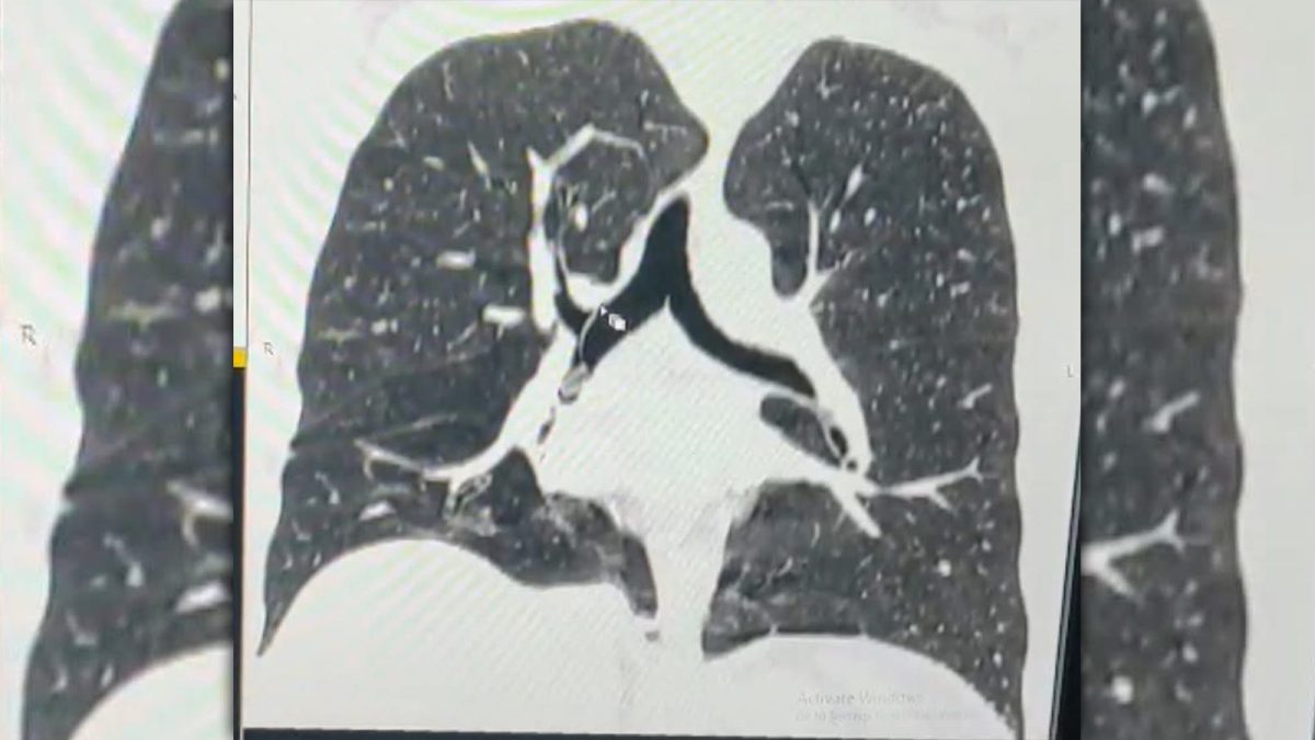 Dorea să facă un tratament pentru durerea de gât, dar a ajuns de urgență la Spitalul Clinic de Pneumoftiziologie Iași, după ce a inspirat o piesă a inhalatorului