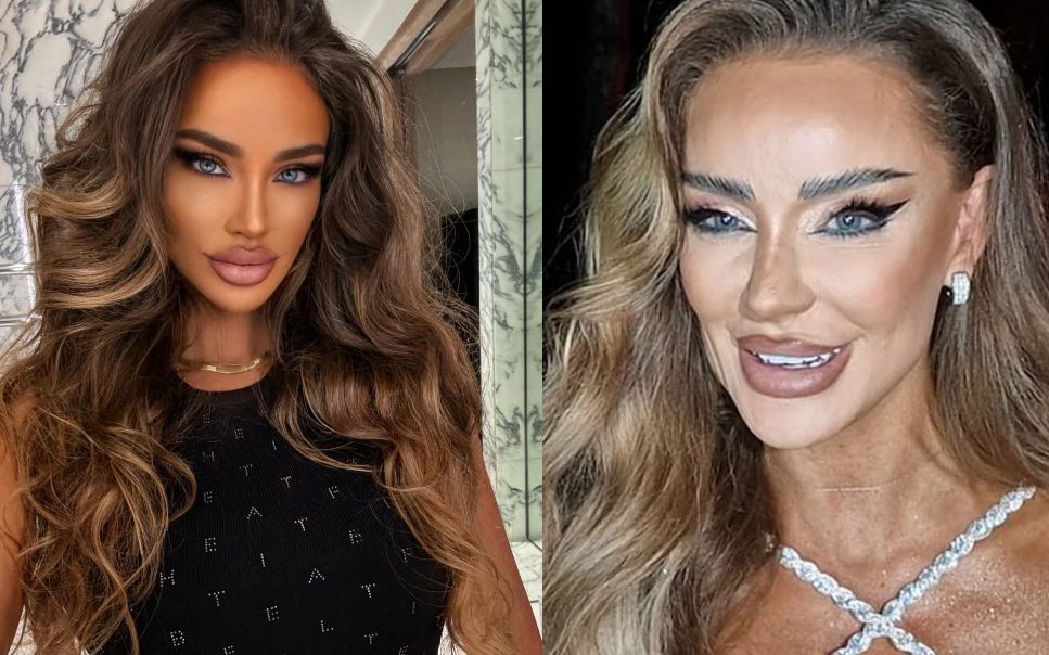 Bianca Drăgușanu, transformare uluitoare după operația de lip lift: „O să mă operez până o să arăt ca și filtrele, pe banii mei”