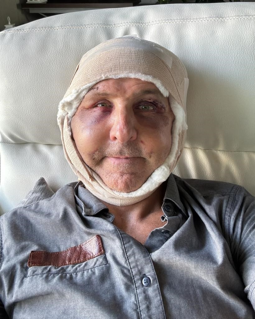 Un bărbat a recurs la o intervenție estetică pentru a părea mai tânăr. Procedura pe care a urmat-o a stârnit multe controverse