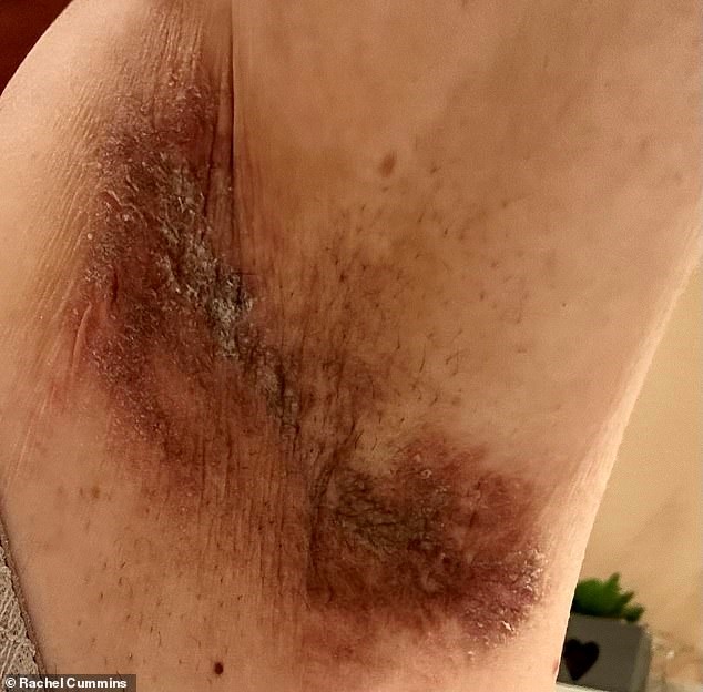 Un brand de antiperspirante se află în mijlocul unui scandal. Femeile acuză că roll-on-ul le-a ars pielea și dau în judecată compania