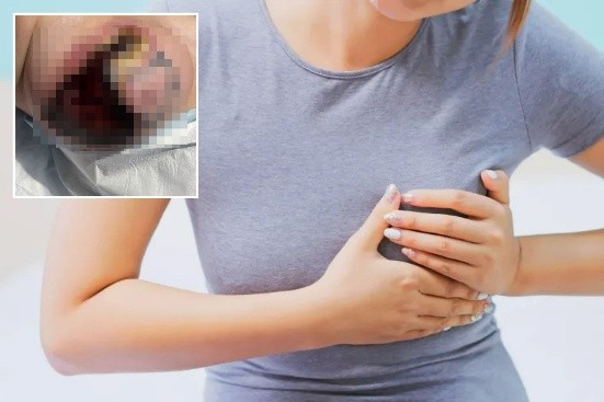 Șocant! O mamă a ajuns de urgență la spital, după ce sânul i s-a înnegrit și a început să se inflameze