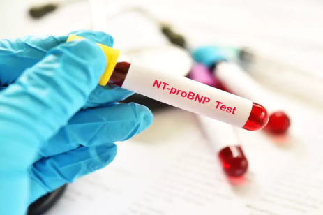 Laboratoarele Praxis : Nt-proBNP – markerul care detectează insuficiența cardiacă înainte de simptome