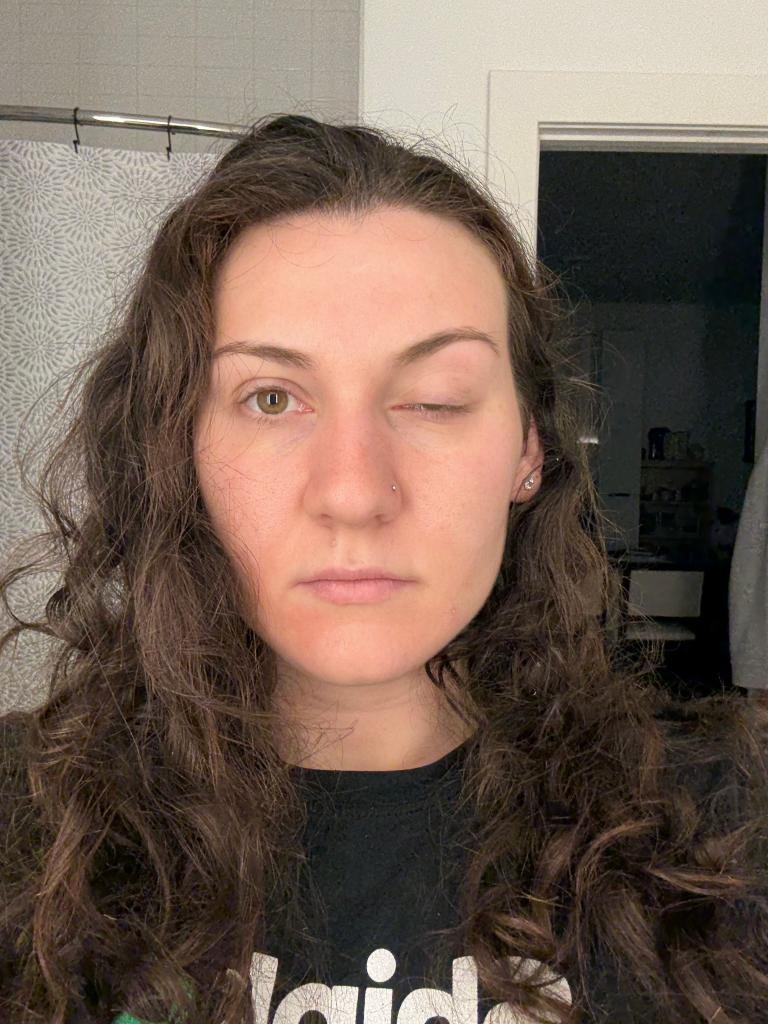 O tânără a rămas defigurată după o intervenție cu botox. Cum a ajuns în această situație?