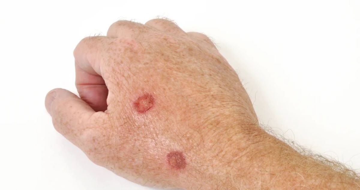 Iată care sunt pozele care te vor ajuta să recunoști un carcinom scuamos! Este a doua cea mai comună formă de cancer de piele!