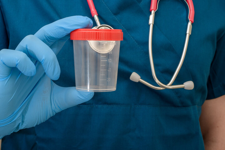 Ce înseamnă urocultură 1.000 UFC/ml? Iată dacă această valoare indică o infecție urinară sau nu