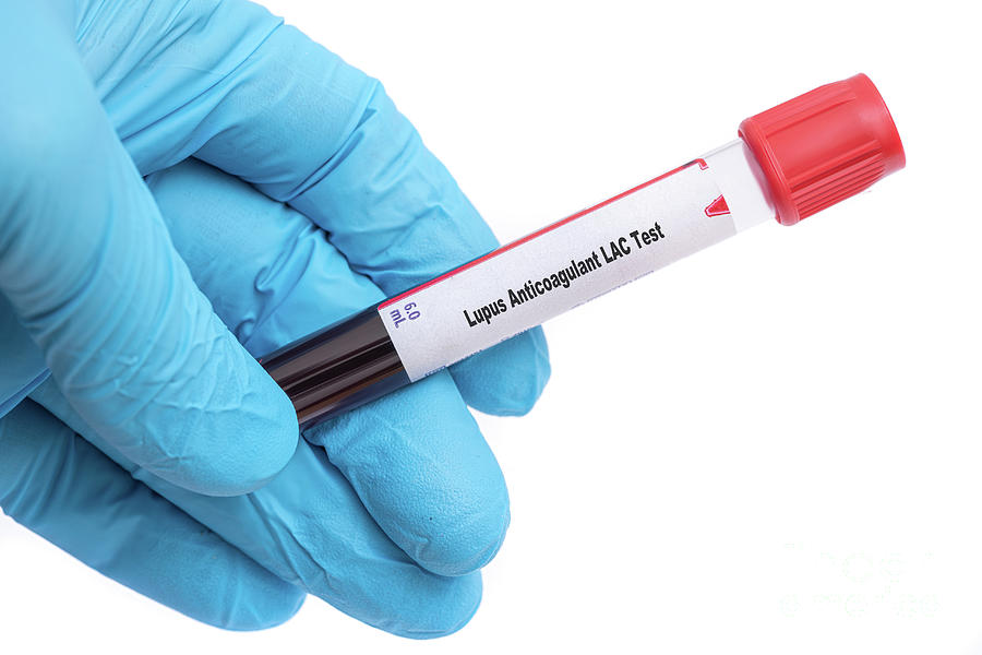 Lupusul anticoagulant. Cauze, simptome și tratament