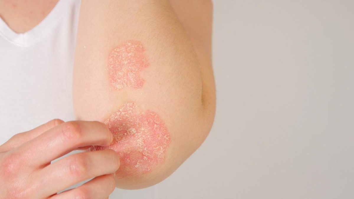 Criza tăcută a psoriazisului. Sute de mii de români suferă în umbră, fără diagnostic și tratament