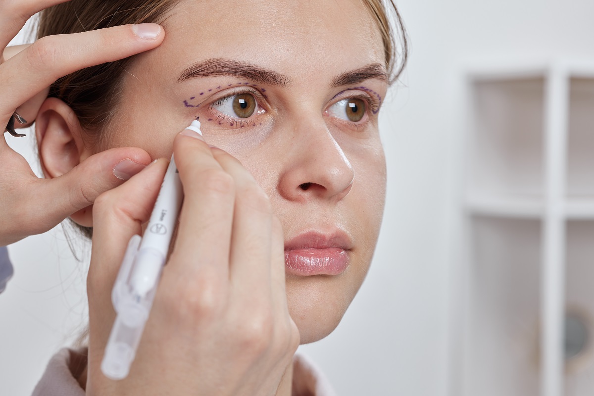 Cum să scapi de pungile de sub ochi: totul despre blefaroplastia inferioară
