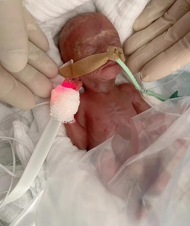 Acest nou-născut a sfidat moartea! Un bebeluș de 300 de grame a supraviețuit după ce a venit pe lume cu 16 săptămâni mai devreme