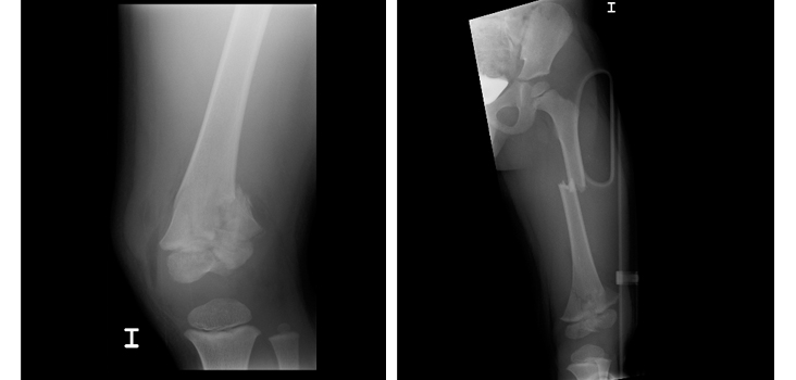 Cum recunoști fractura de femur? Iată care sunt complicațiile care pot apărea!
