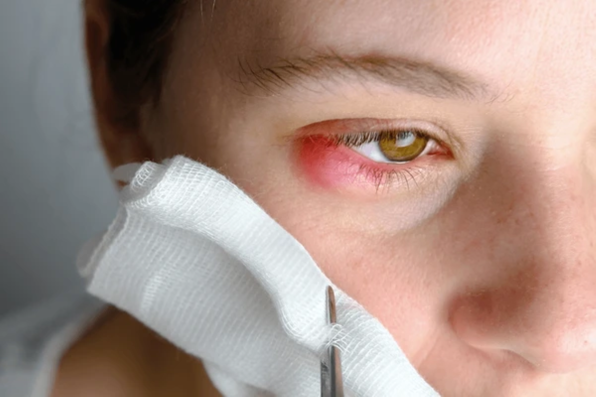 Herpesul ocular, o afecțiune care necesită atenție! Află dacă poate cauza pierderea vederii!