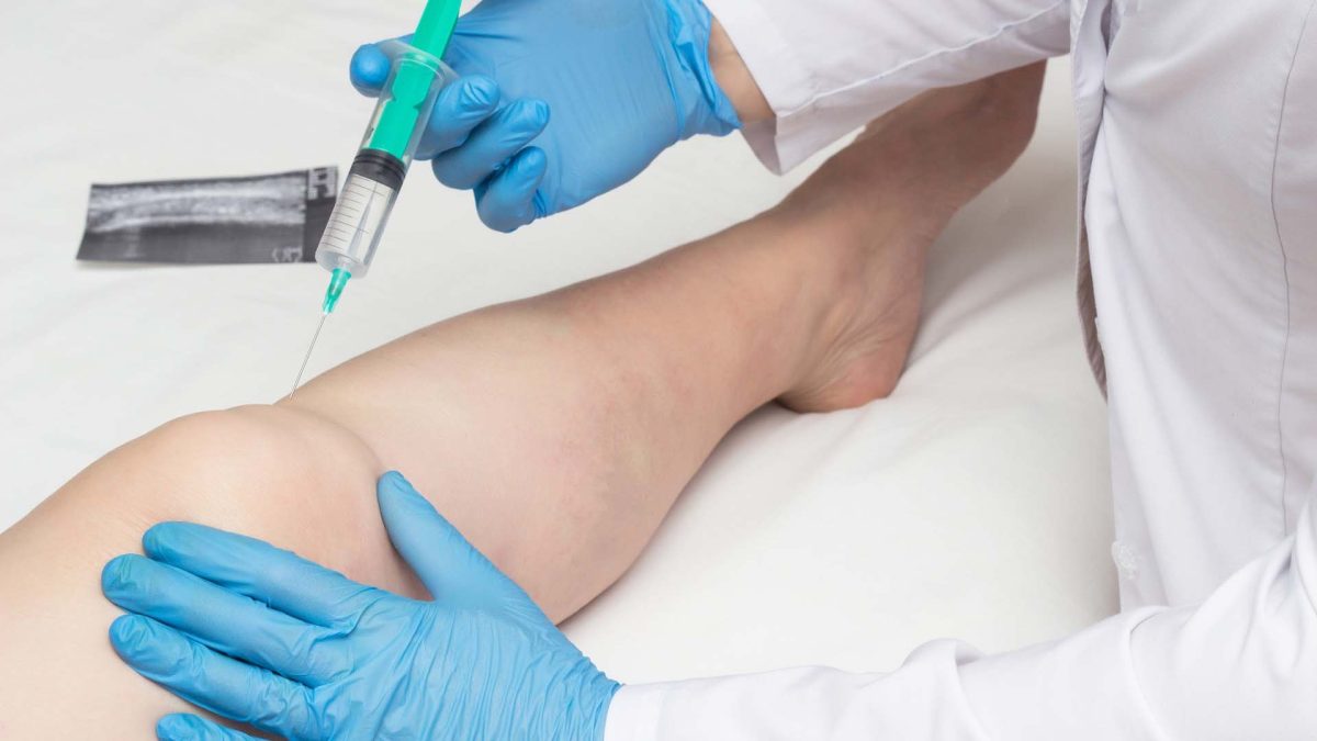 Păreri pentru injecțiile cu acid hialuronic la genunchi – Iată tot ce trebuie să știi pentru tratarea durerilor articulare
