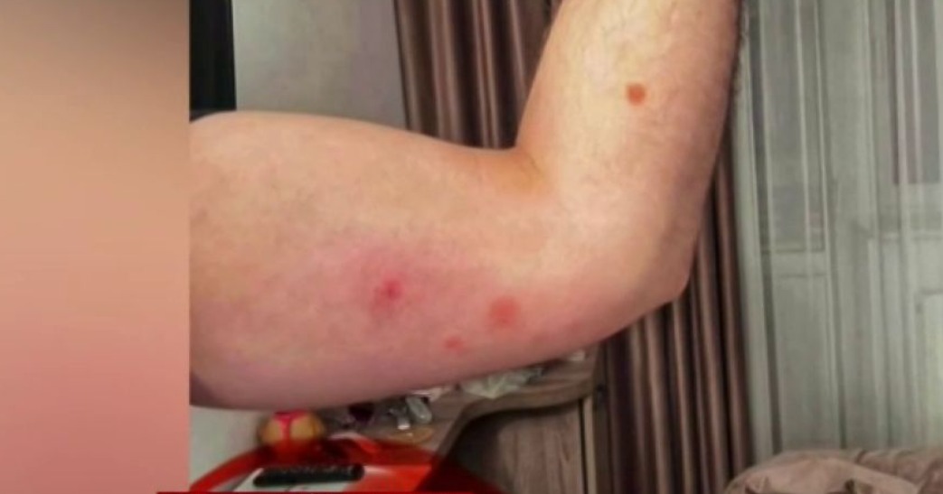 Vacanță de coșmar în Predeal! Un turist a fost mușcat de ploșnițe și a ajuns de urgență la spital
