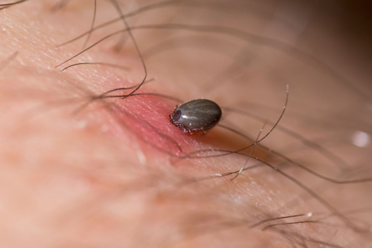 Eritem migrator, semnul care poate fi descoperit pe corp după o înțepătură de căpușă! Un simptom precoce al bolii Lyme!