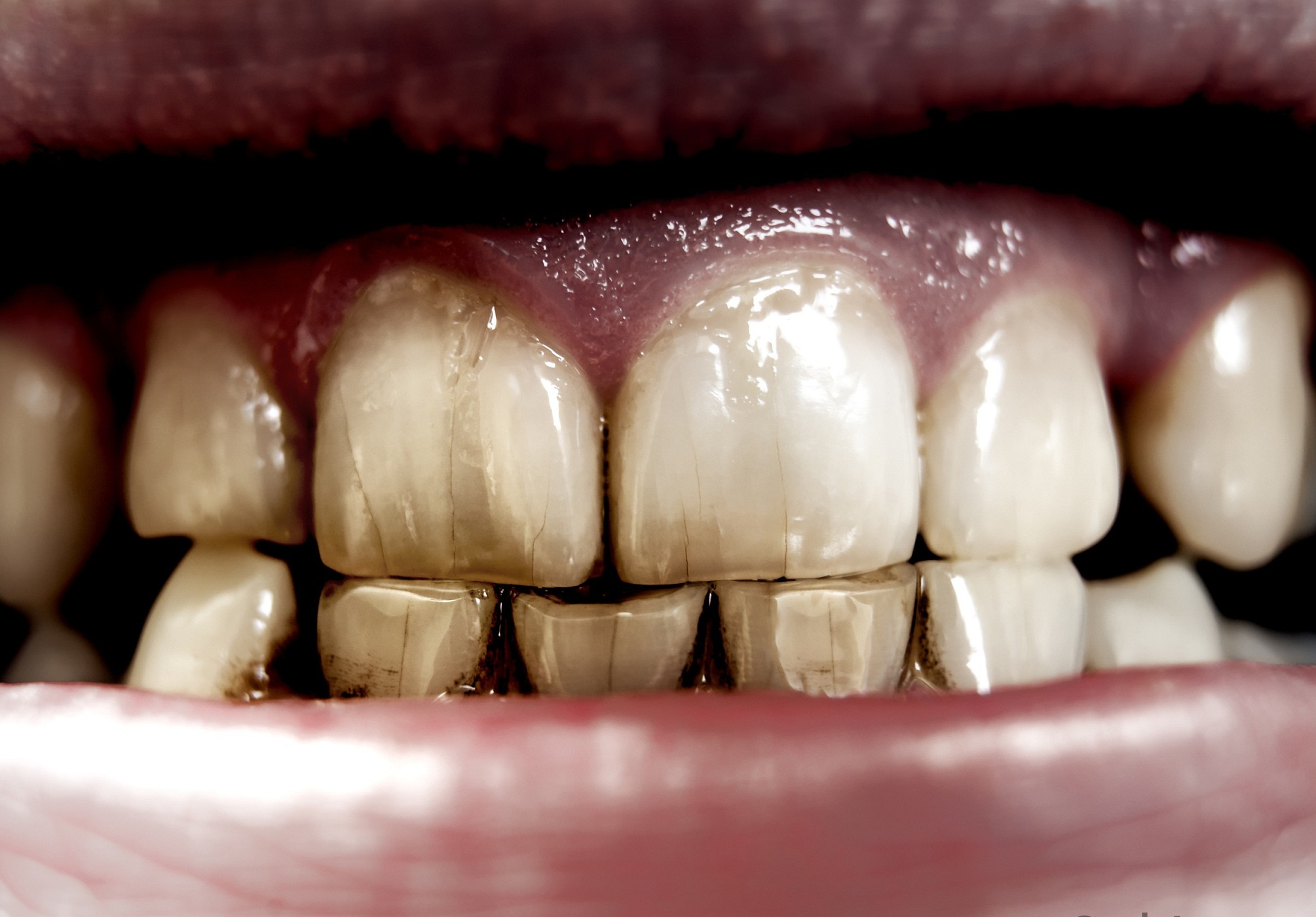 Меловидно крапчатый флюороз. Зубы как можно зубы отбелить. Гиперестезия эмали зубов. Чувствительность зуба причины. Повышение чувствительности зубов.