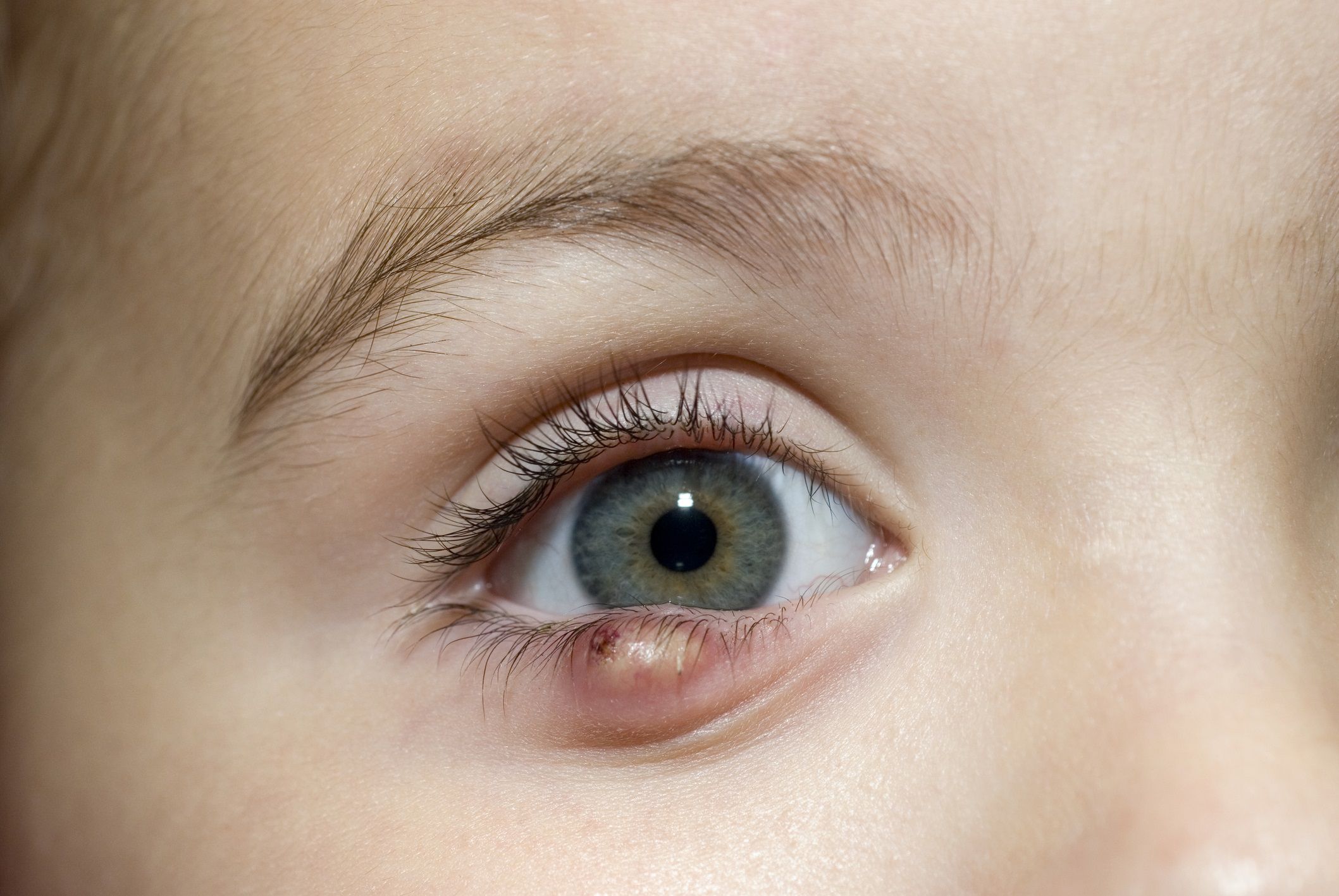 Как вылечить ячмень у ребенка на глазу. Глазной ячмень халязион.