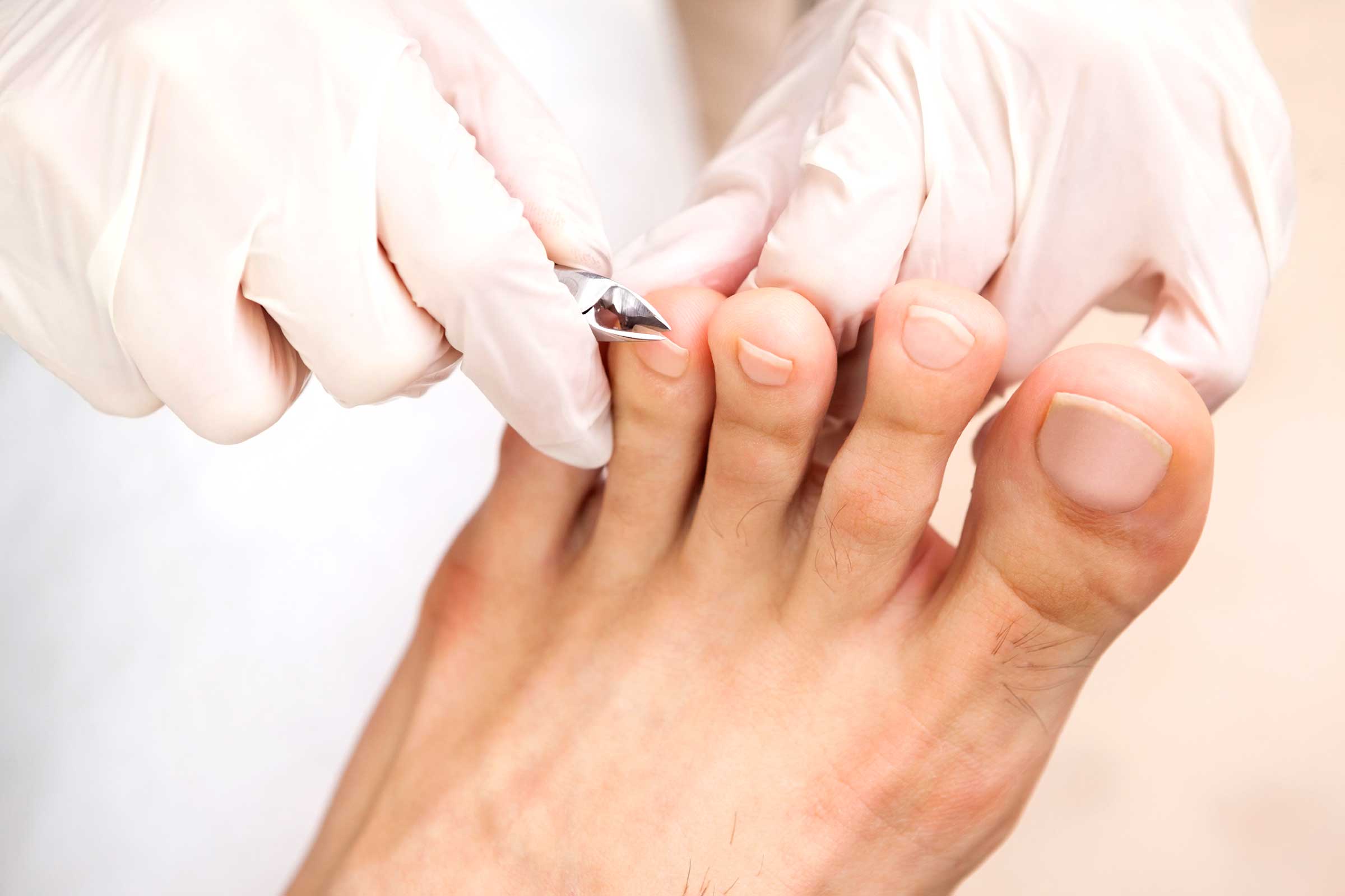 de ce nu ar trebui să-ți tai unghiile de la picioare afectate de ciuperci