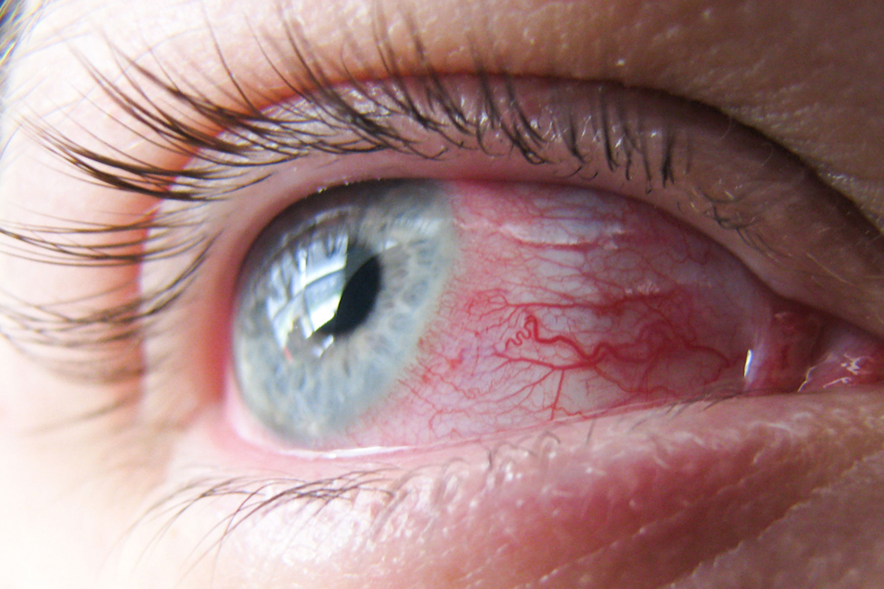 boala ochilor rosii