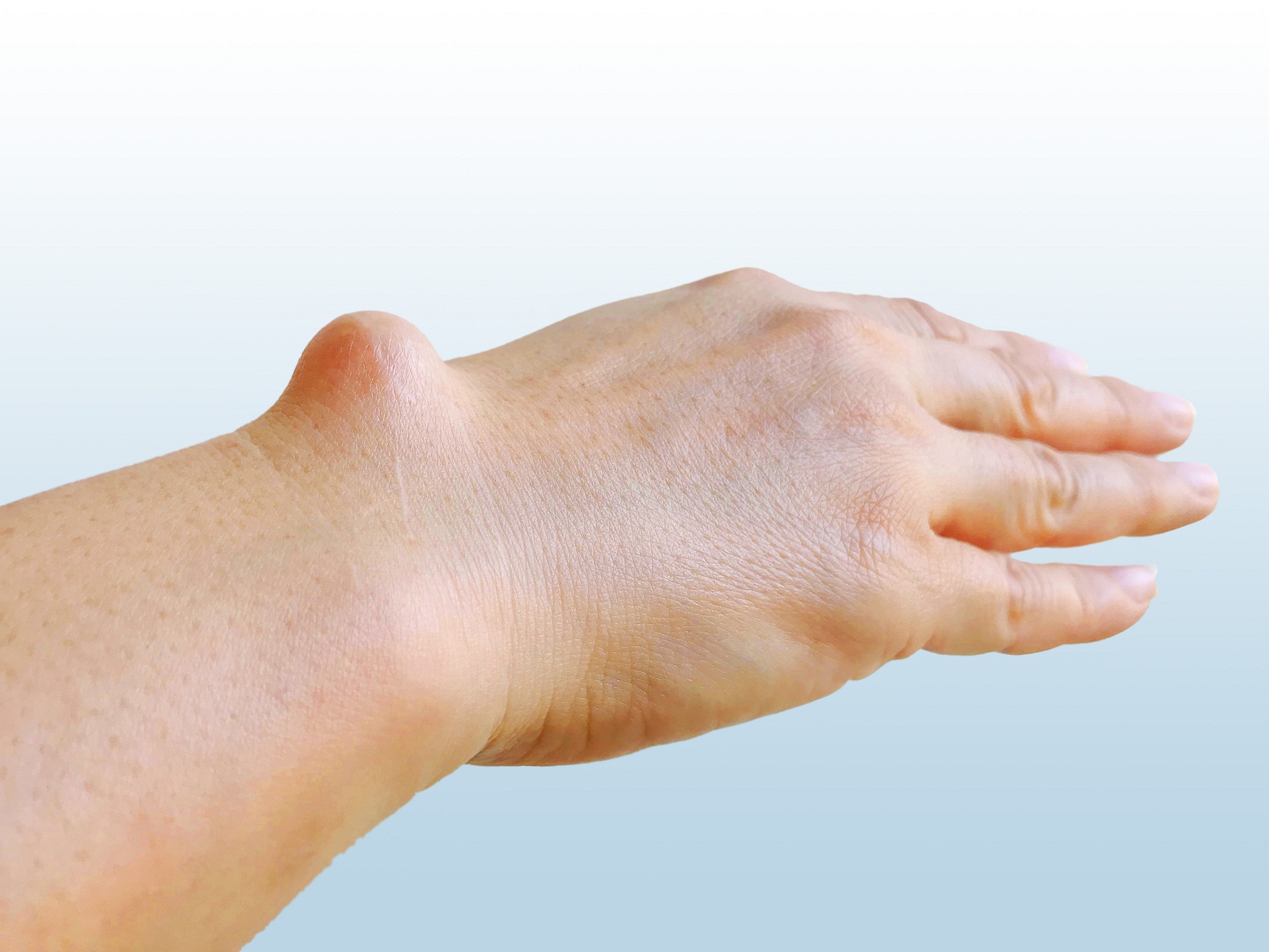 chist sinovial tratamentul artrozei genunchiului cu nanotehnologie
