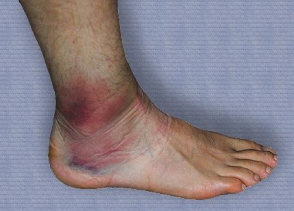 Tratamentul mobil al articulațiilor genunchiului tratamentul acupuncturii artrozei șoldului
