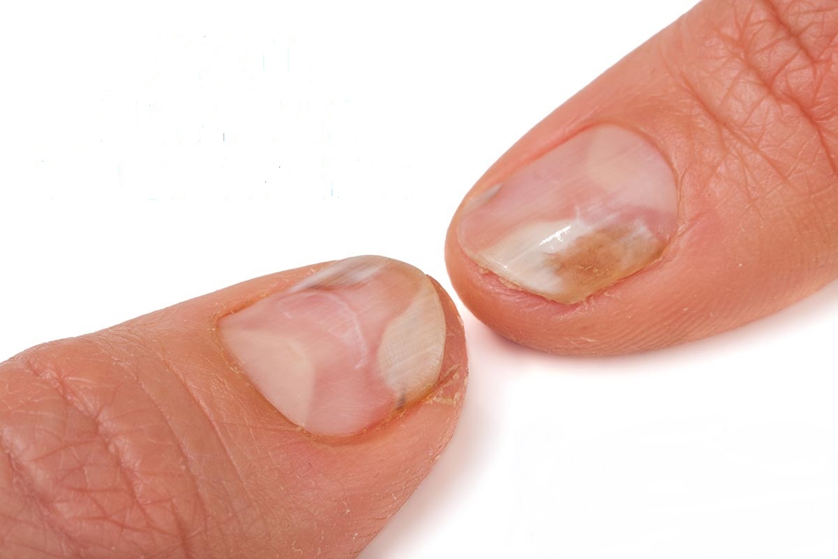 test negativ pentru ciuperca unghiilor de la picioare