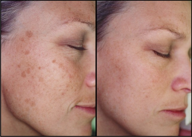 de ce apare pigmentarea pe față piele grasă anti-îmbătrânire