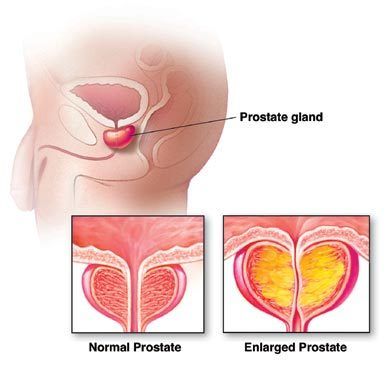 Prostata marita sau adenomul de prostata