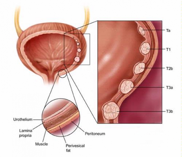 cheaguri de sange in vezica urinara inflamatia prostata