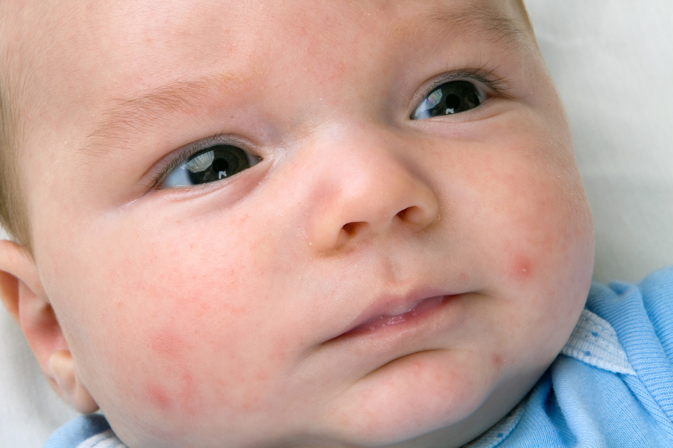 Ребенку год красные щеки. Неонатальный цефалический пустулез. Цефалический пустулез новорожденных. Гнейс атопический дерматит.