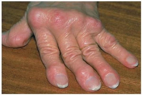tratament guta maini artrita traumatică pentru tratamentul degetelor