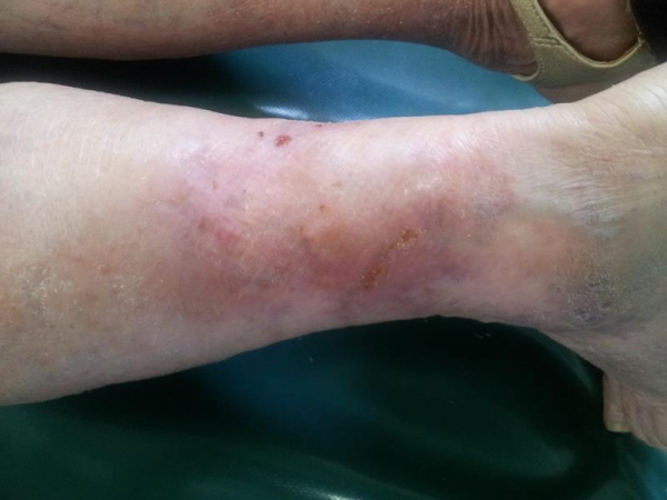Edemul picioarelor cu tratament folic varicos