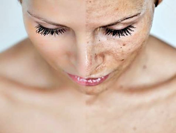 Amestecul natural care te ajuta sa scapi de petele pigmentare si alte afectiuni ale pielii