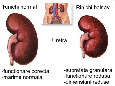 imagini rinichi bolnav