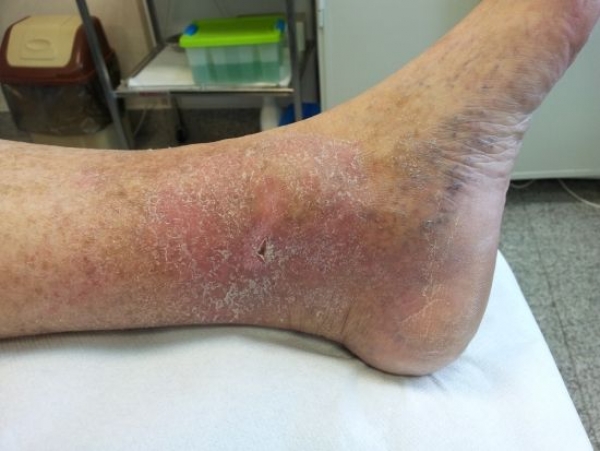 insuficienta venoasa picioare simptome