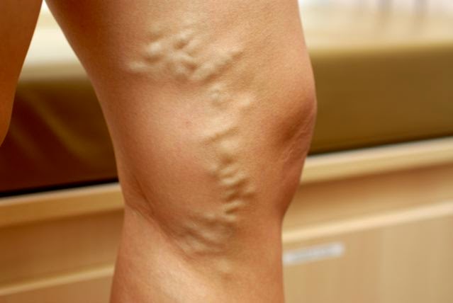 fotografiile de picior varicoase hurring picioare cu varicoză