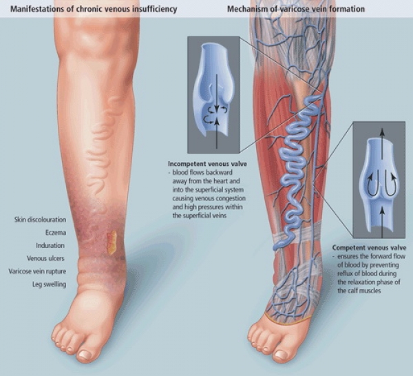 tratamentul piciorului de argilă varico tratamentul funcționării rezultatelor varicoase