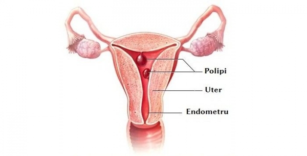 Polip endometrial - cauze, simptome, tratament!