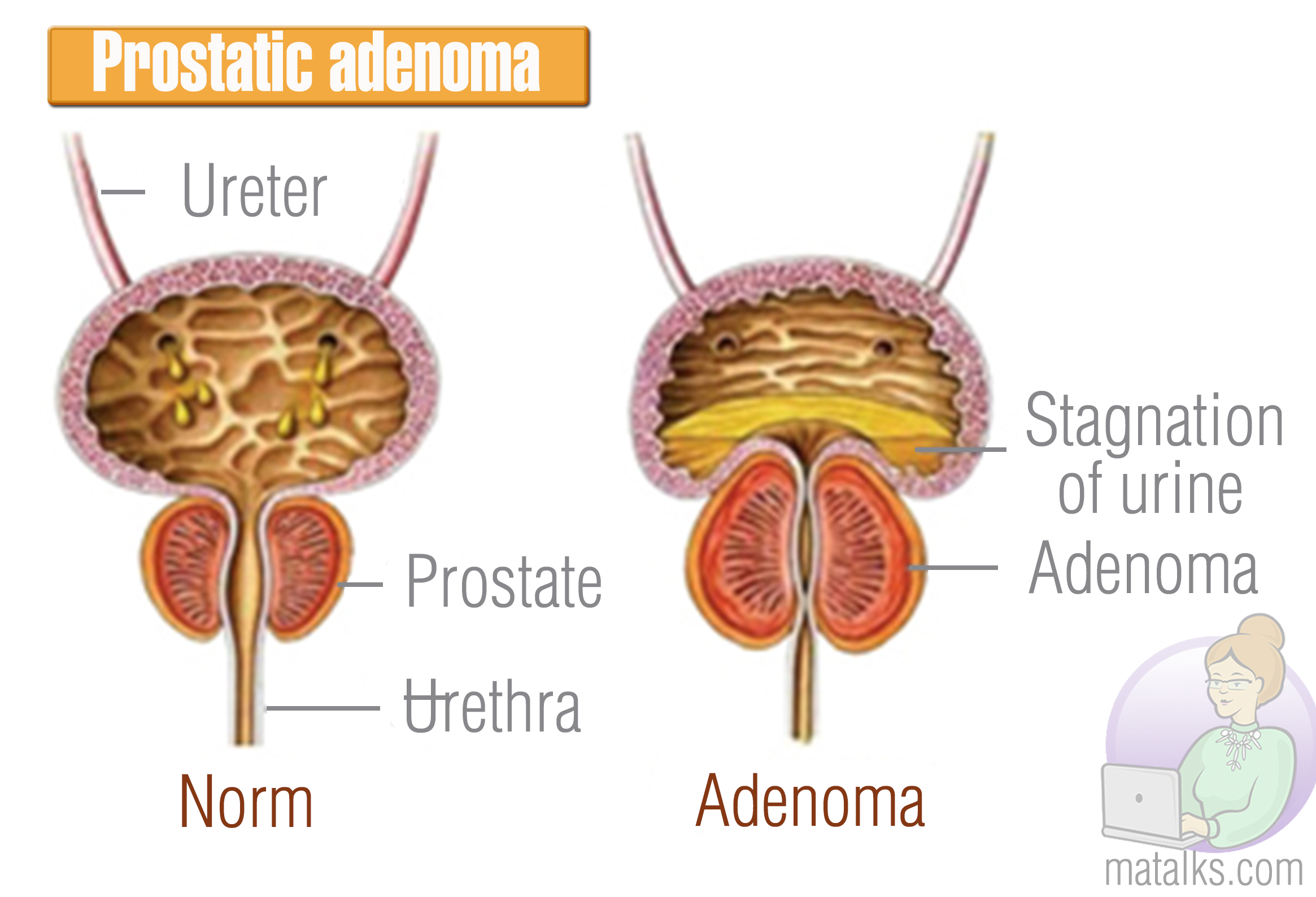 cum să vindeci adenom și prostatita)