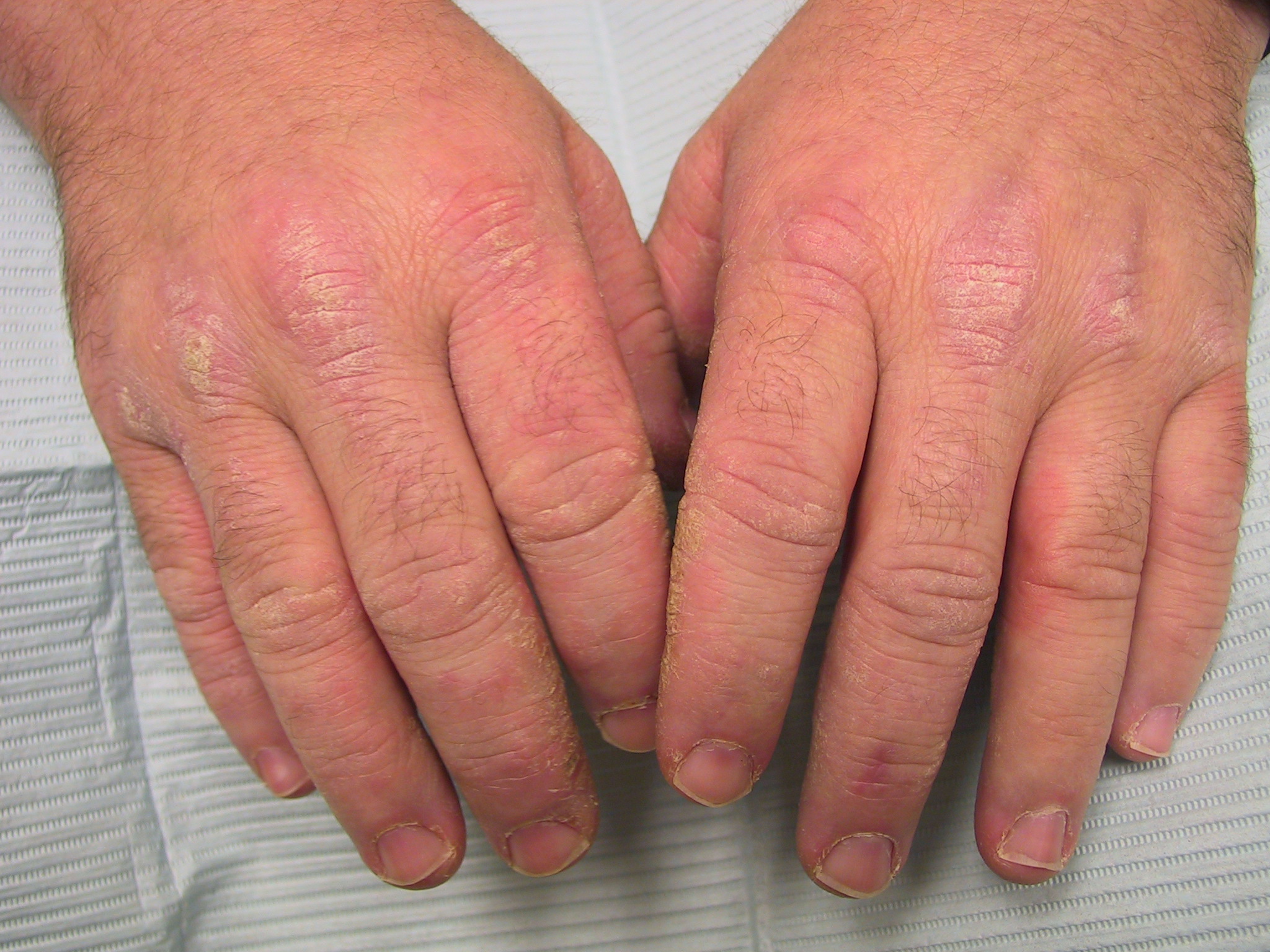 dureri articulare Sindromul Reiter osteoartroza istoricului medical al articulației șoldului